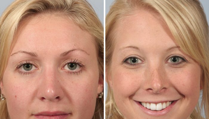 Rhinoplasty (Nose surgery) at Younger Facial Surgery Centre in Vancouver. 