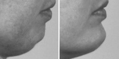 Before & After chin Surgery - Dr. Younger in Vancouver