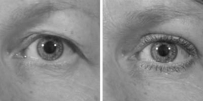 Before & After eyelid Surgery - Dr. Younger in Vancouver
