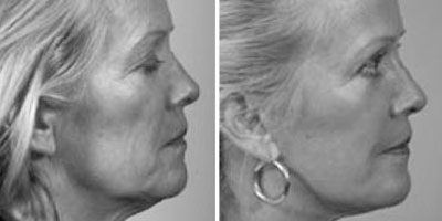 Before & After Facelift - Dr. Younger in Vancouver
