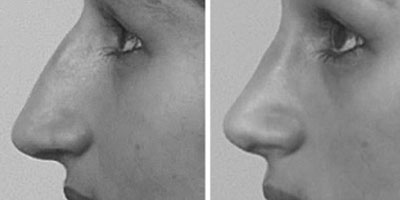 Before & After Nose Surgery - Dr. Younger in Vancouver