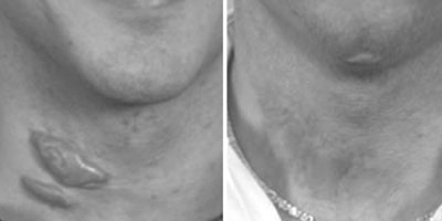 Before & After Scar Revision Surgery - Dr. Younger in Vancouver