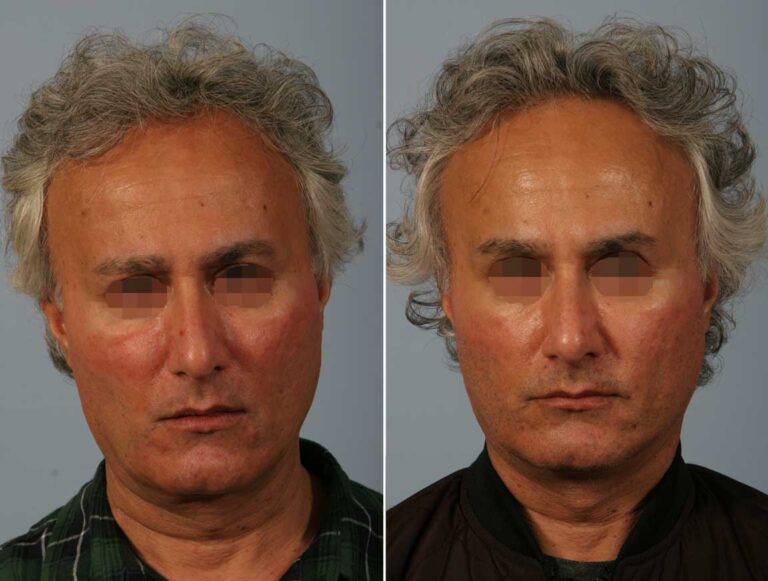 facelift-bleph-ba-front-4522-768x581