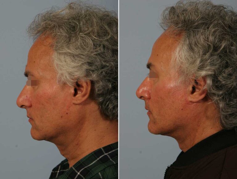 facelift-bleph-ba-left-4522-768x581