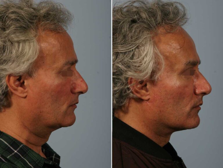 facelift-bleph-ba-right-4522-768x581