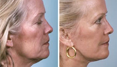 Image of before and after facelift surgery